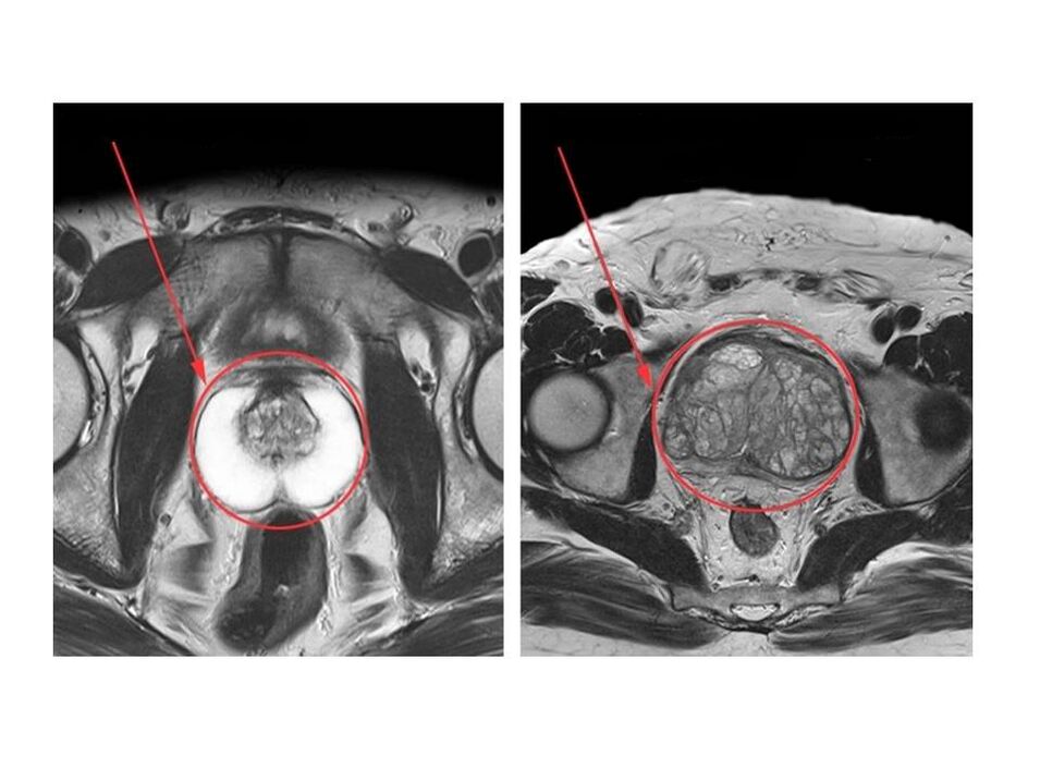 Comparison of healthy (left) and inflamed (right) prostate on MRI images